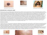 меланома фото начальная стадия
https://melanoma.pp.ua